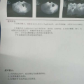 在医院做b超被 春雨,B超检查，精准守护健康之路